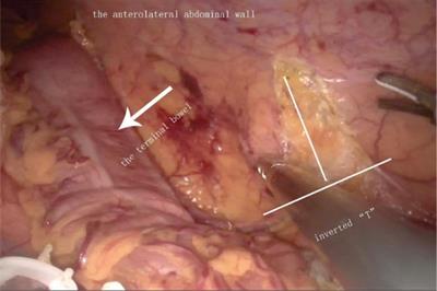 A Modified Surgical Technique to Prevent Parastomal Hernia